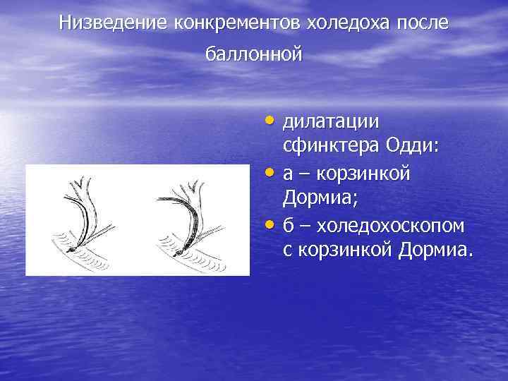 Низведение конкрементов холедоха после баллонной • дилатации • • сфинктера Одди: а – корзинкой