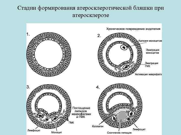 Стадии формирования атеросклеротической бляшки при атеросклерозе 