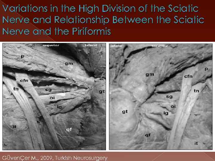 Variations in the High Division of the Sciatic Nerve and Relationship Between the Sciatic