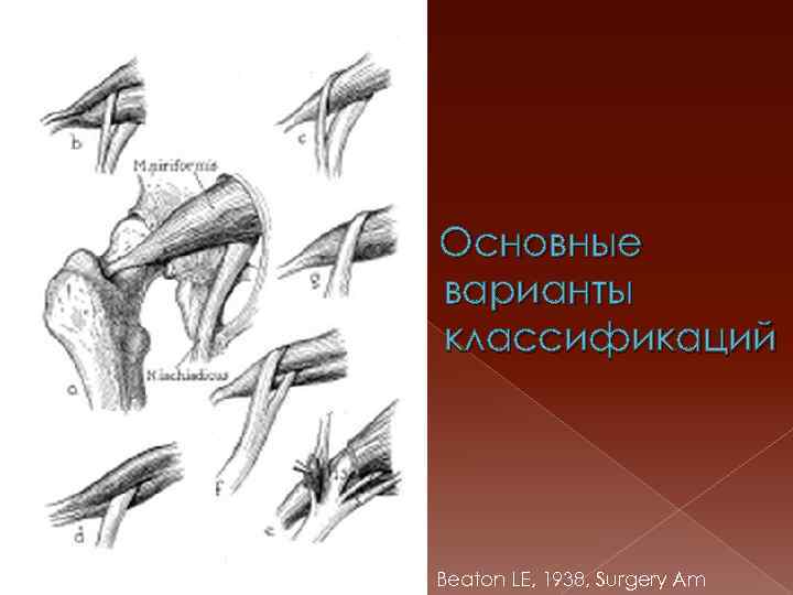 Основные варианты классификаций Beaton LE, 1938, Surgery Am 