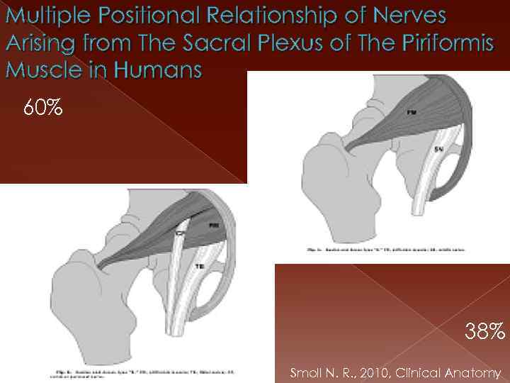 Multiple Positional Relationship of Nerves Arising from The Sacral Plexus of The Piriformis Muscle