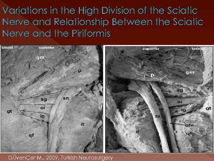 Variations in the High Division of the Sciatic Nerve and Relationship Between the Sciatic