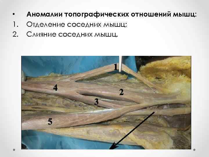 • 1. 2. Аномалии топографических отношений мышц: Отделение соседних мышц; Слияние соседних мышц.
