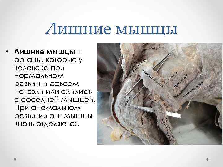 Лишние мышцы • Лишние мышцы – органы, которые у человека при нормальном развитии совсем
