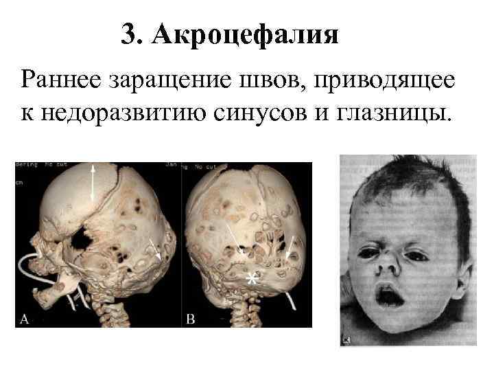 3. Акроцефалия Раннее заращение швов, приводящее к недоразвитию синусов и глазницы. 