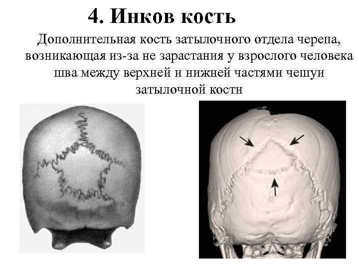 4. Инков кость Дополнительная кость затылочного отдела черепа, возникающая из-за не зарастания у взрослого