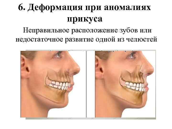 Оперативное лечение при аномалиях и деформациях верхней челюсти презентация