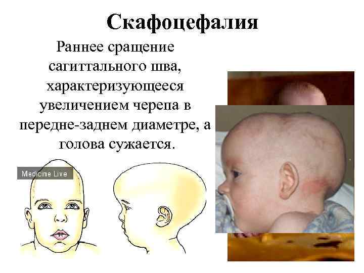 Скафоцефалия Раннее сращение сагиттального шва, характеризующееся увеличением черепа в передне-заднем диаметре, а голова сужается.