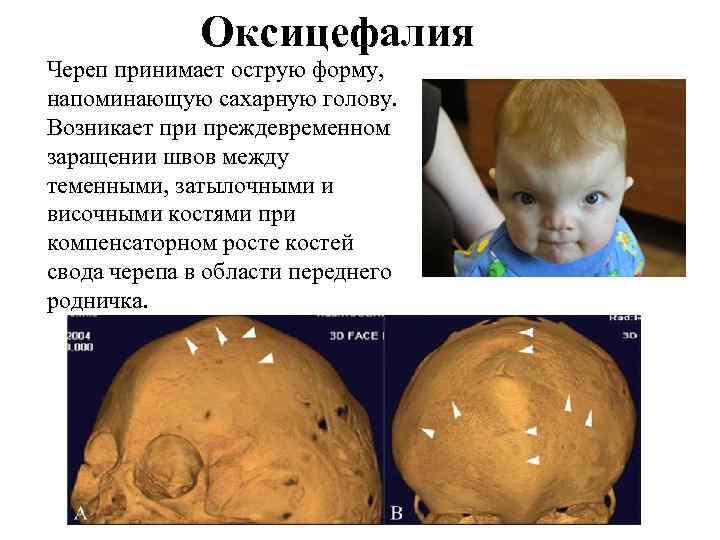 Оксицефалия Череп принимает острую форму, напоминающую сахарную голову. Возникает при преждевременном заращении швов между
