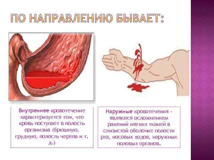 Внутреннее кровотечение характеризуется тем, что кровь поступает в полость организма (брюшную, грудную, полость черепа