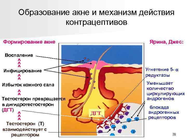 Образование акне и механизм действия контрацептивов Формирование акне Ярина, Джес: Воспаление ^ ^ ^