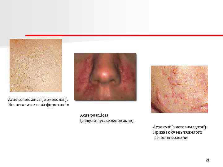 Acne comedonica ( комедоны ). Невоспалительная форма акне Acne pustulosa (папуло-пустолезное акне). Acne cyst