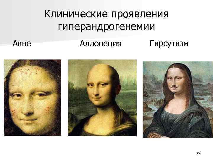 Клинические проявления гиперандрогенемии Акне Аллопеция Гирсутизм 26 