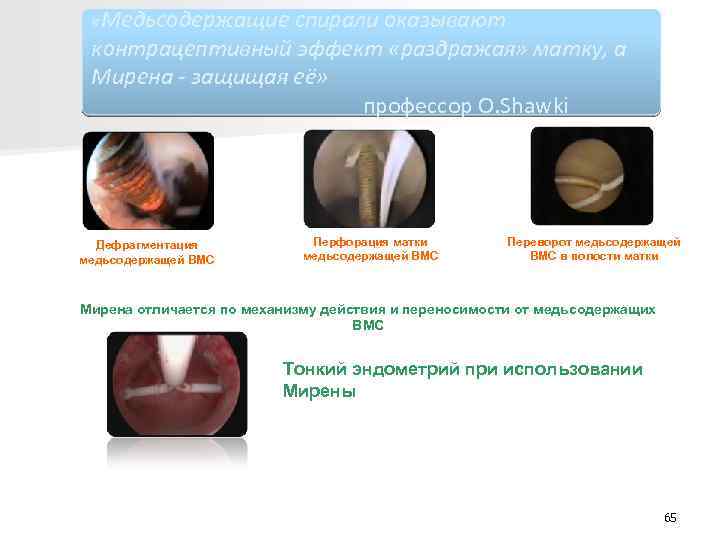  «Медьсодержащие спирали оказывают контрацептивный эффект «раздражая» матку, а Мирена - защищая её» профессор