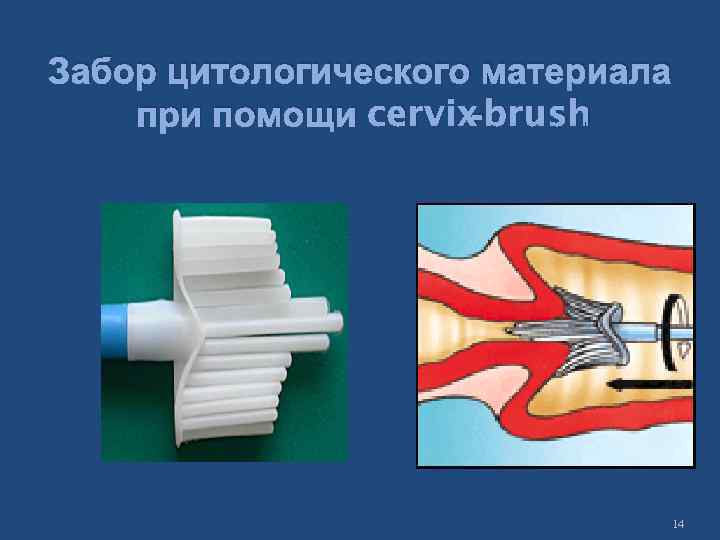 Забор цитологического материала при помощи cervix-brush 14 