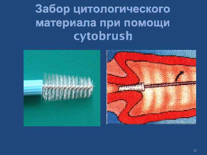 Забор цитологического материала при помощи. cytobrush 15 