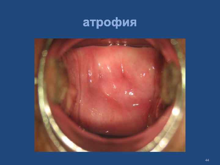 атрофия 44 