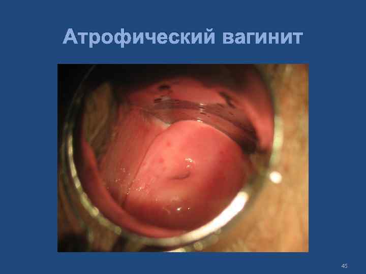 Атрофический вагинит 45 