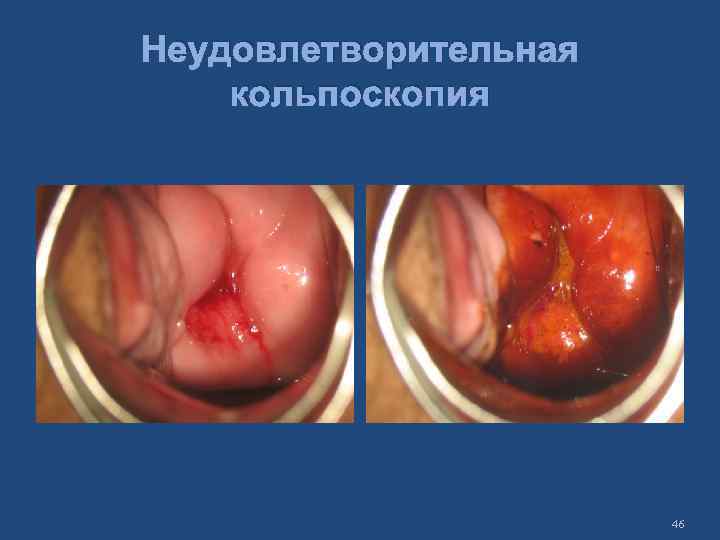 Неудовлетворительная кольпоскопия 46 