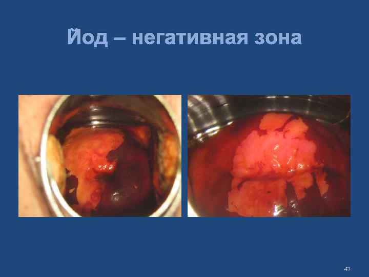 Йод – негативная зона 47 