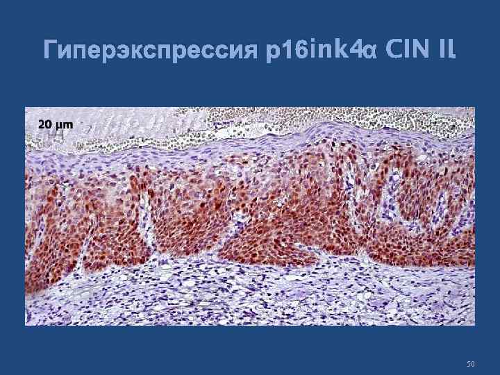 Гиперэкспрессия р16 ink 4α CIN II. 50 
