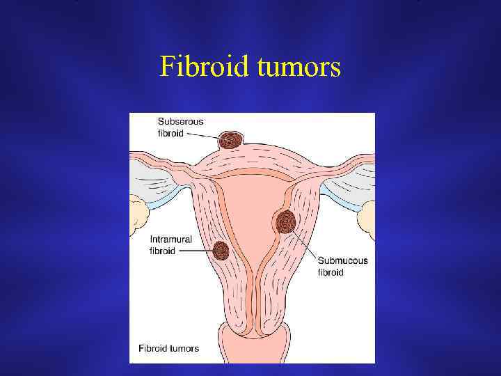 Fibroid tumors 