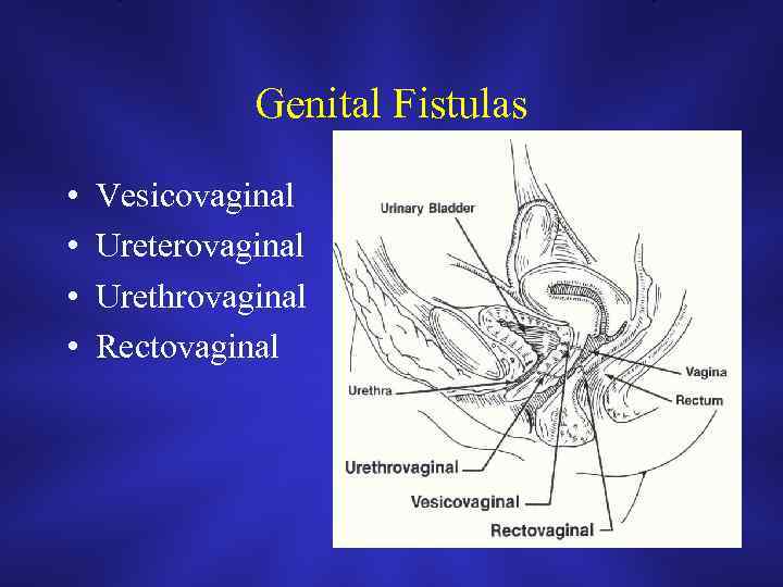 Genital Fistulas • • Vesicovaginal Ureterovaginal Urethrovaginal Rectovaginal 