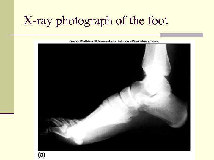 X-ray photograph of the foot 