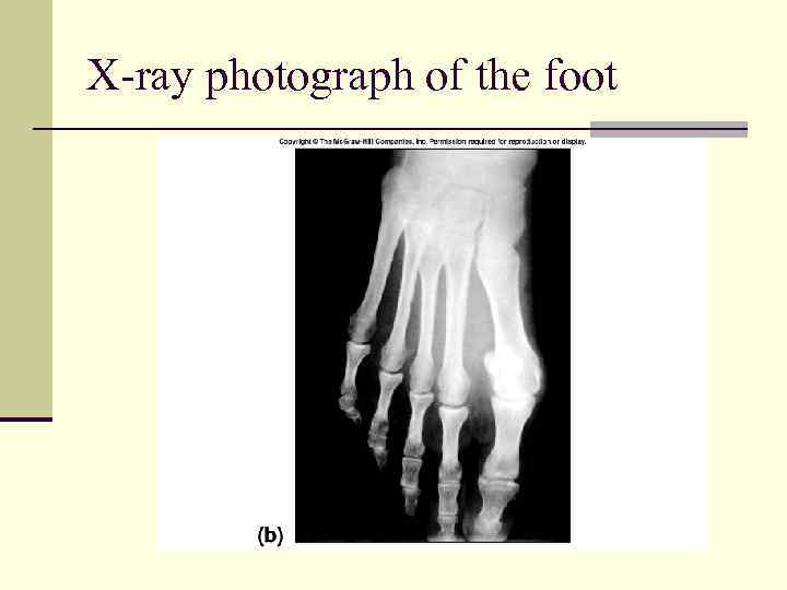 X-ray photograph of the foot 