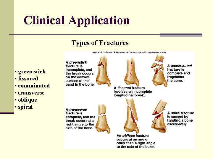 Clinical Application Types of Fractures • green stick • fissured • comminuted • transverse