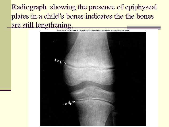 the presence of an epiphyseal plate indicates that
