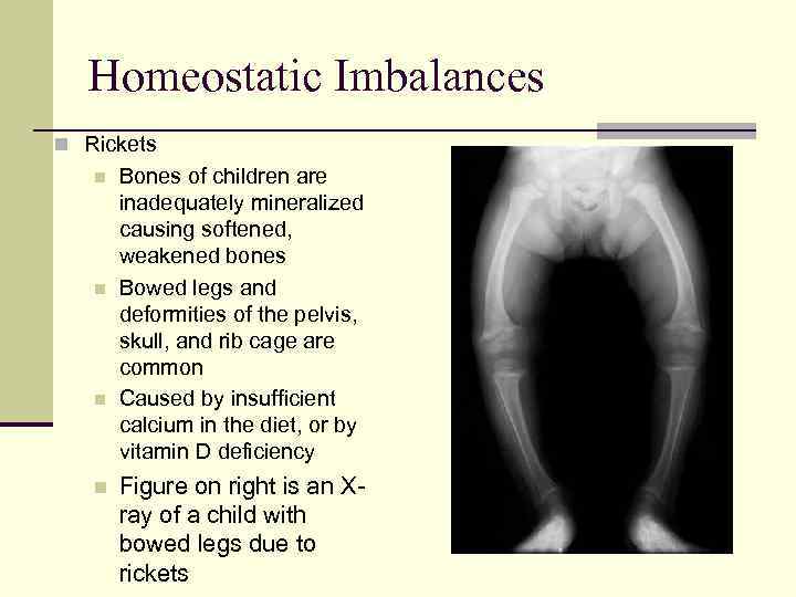 Homeostatic Imbalances n Rickets n n Bones of children are inadequately mineralized causing softened,