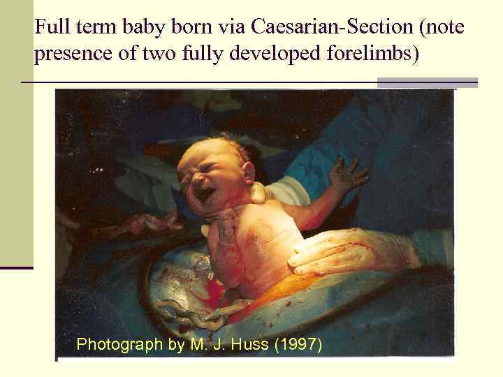 Full term baby born via Caesarian-Section (note presence of two fully developed forelimbs) Photograph