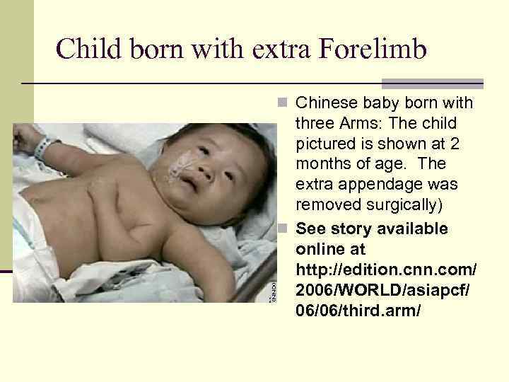 Child born with extra Forelimb n Chinese baby born with three Arms: The child