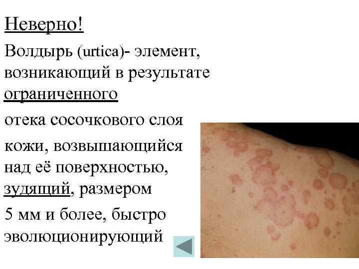 Неверно! Волдырь (urtica)- элемент, возникающий в результате ограниченного отека сосочкового слоя кожи, возвышающийся над