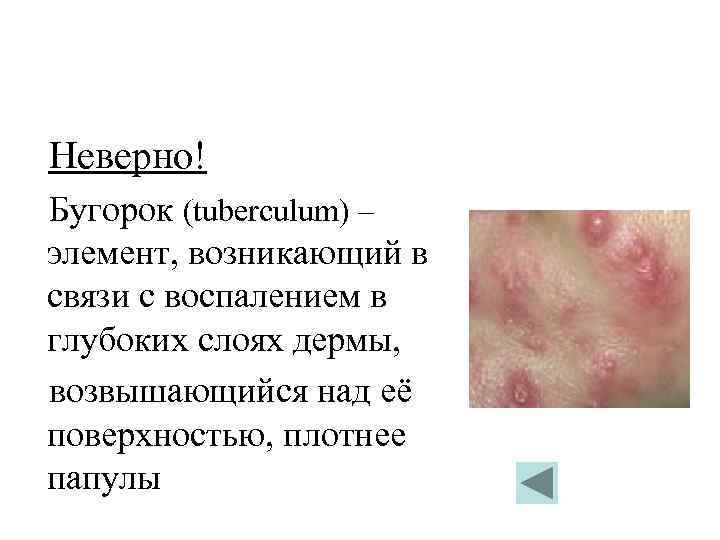 Неверно! Бугорок (tuberculum) – элемент, возникающий в связи с воспалением в глубоких слоях дермы,