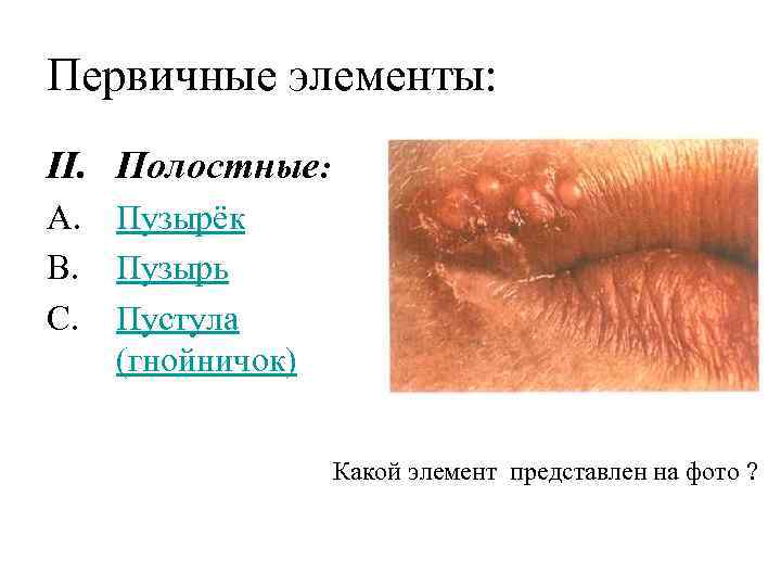 Первичные элементы: II. Полостные: A. Пузырёк B. Пузырь C. Пустула (гнойничок) Какой элемент представлен