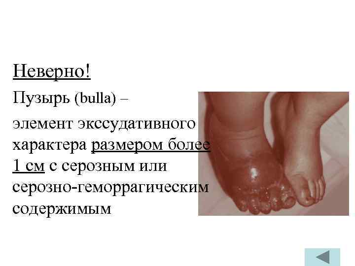Неверно! Пузырь (bulla) – элемент экссудативного характера размером более 1 см с серозным или