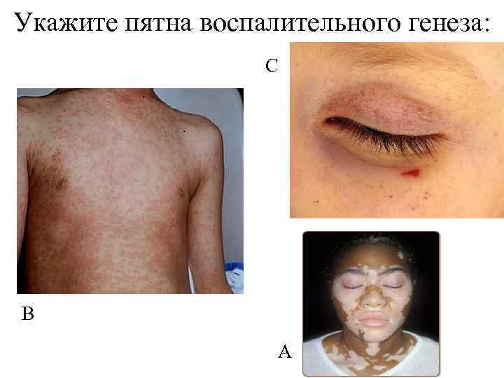 Укажите пятна воспалительного генеза: С С В А 