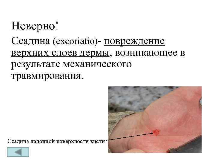 Неверно! Ссадина (excoriatio)- повреждение верхних слоев дермы, возникающее в результате механического травмирования. Ссадина ладонной