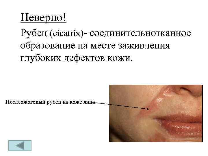 Неверно! Рубец (cicatrix)- соединительнотканное образование на месте заживления глубоких дефектов кожи. Послеожоговый рубец на