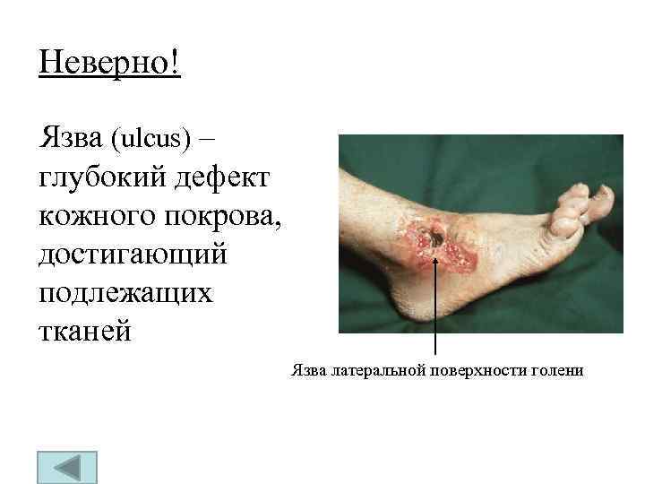 Неверно! Язва (ulcus) – глубокий дефект кожного покрова, достигающий подлежащих тканей Язва латеральной поверхности
