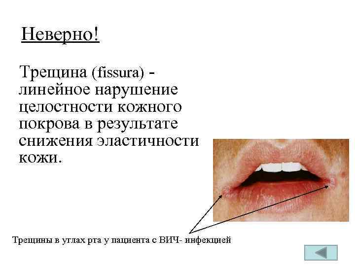 Неверно! Трещина (fissura) - линейное нарушение целостности кожного покрова в результате снижения эластичности кожи.