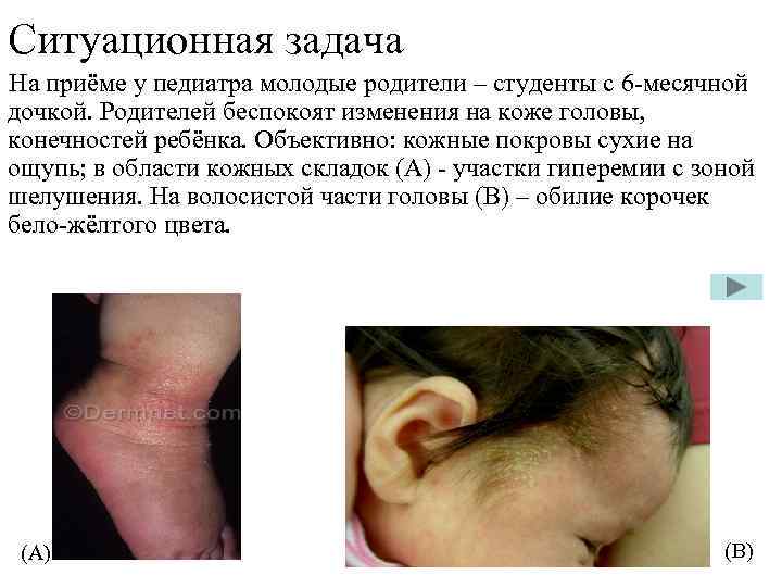 Ситуационная задача На приёме у педиатра молодые родители – студенты с 6 -месячной дочкой.