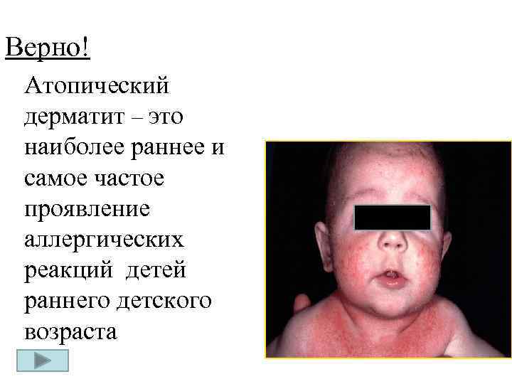 Верно! Атопический дерматит – это наиболее раннее и самое частое проявление аллергических реакций детей