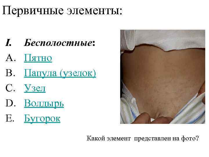 Первичные элементы: I. A. B. C. D. E. Бесполостные: Пятно Папула (узелок) Узел Волдырь