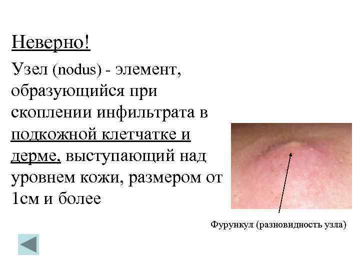 Неверно! Узел (nodus) - элемент, образующийся при скоплении инфильтрата в подкожной клетчатке и дерме,