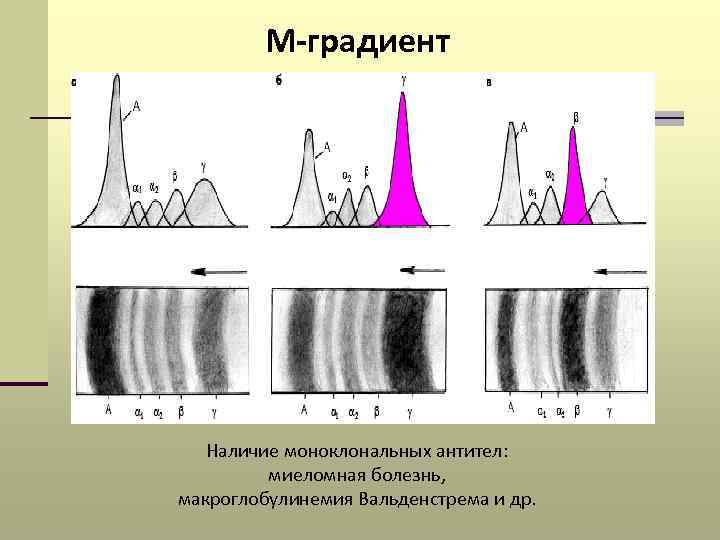 М градиент. М градиент при электрофорезе белков сыворотки крови. Электрофорез белков сыворотки крови при миеломной болезни. Миеломная болезнь м градиент. М-градиент в крови при миеломной болезни.