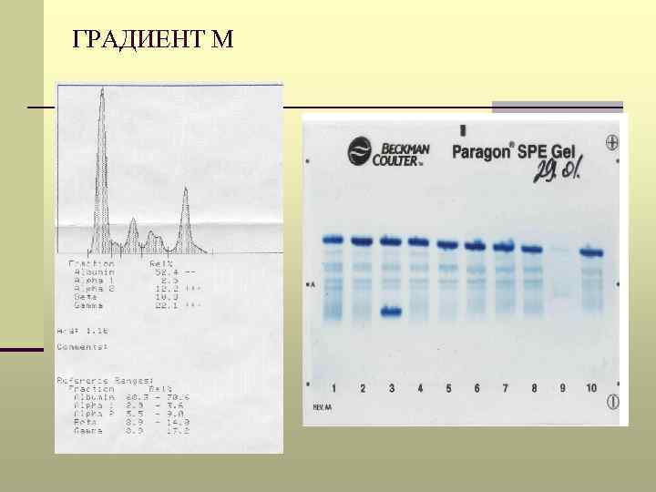 М градиент при электрофорезе белков сыворотки крови. Электрофорез белков м градиент. М градиент.