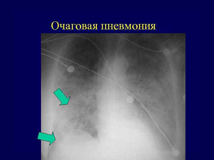 Очаговая пневмония 